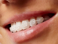 Fixed ceramic braces